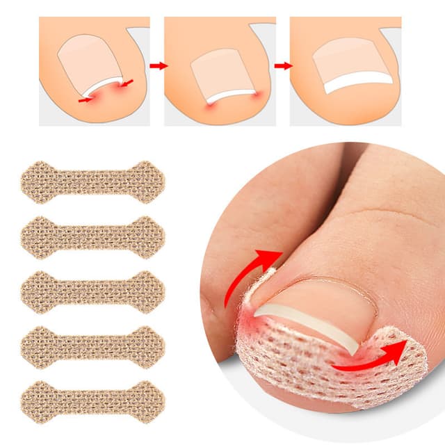 Gips for inngrodde tånegler Beige