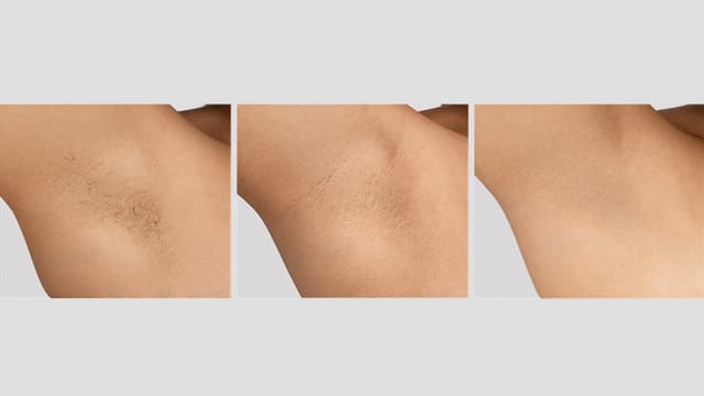 Kolme rinnakkaista kuvaa kainalosta, jossa näkyy Braun IPL -laitteen tarjoma tulos ihokarvojen vähentymiselle