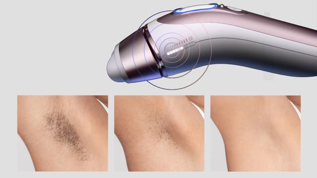 Illustrasjon av Braun Smart IPL hårfjerningsapparat over tre bilder side om side som viser gradvis effekt av behandling.