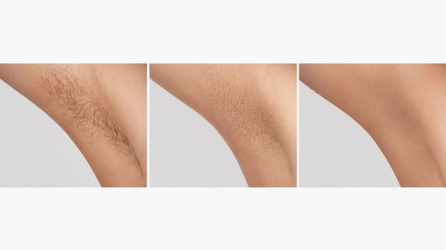 Tre billeder af en armhule med gradvist mindre hår, der viser de synlige resultater af Braun IPL Silk·expert Mini